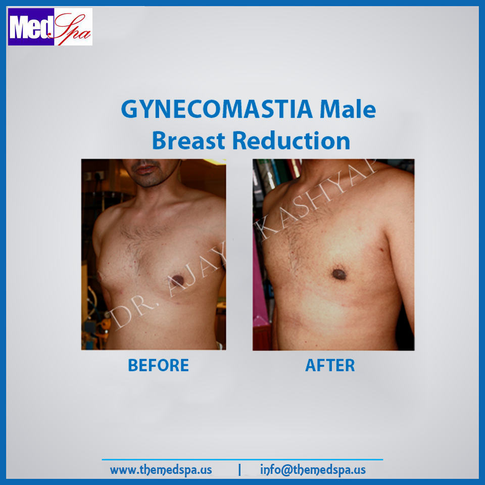 gynecomastia-male-breast-reduction-delhi-india-by-drajayakashyap
