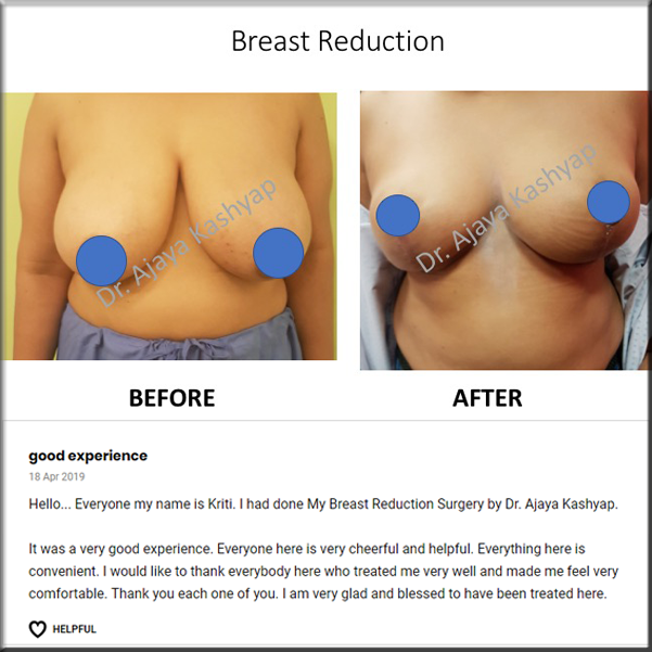 breast reduction surgery in Delhi